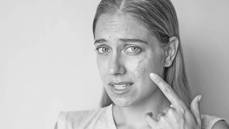 Best Acne Scar Treatment in delhi 